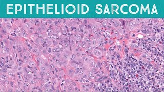 Epithelioid sarcoma explained in 5 minutes pathology dermpath dermatopathology dermatology [upl. by Arriaes]