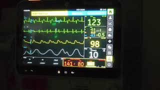 Ventricular Bigeminy [upl. by Solberg]