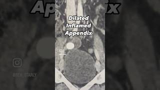 appendicitis computedtomography abdomen acute radiology [upl. by Camroc818]