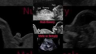 Nub theorymale or femalepregnancy ultrasoundbabyshorts [upl. by Yci]