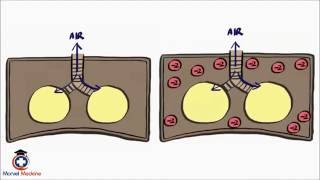 Pneumothorax and Tension Pneumothorax [upl. by Daugherty939]