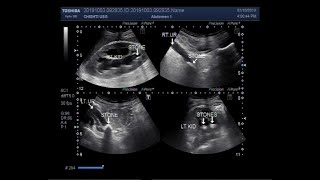 Ultrasound Video showing a stone in ureter of both kidneys [upl. by Aivatnuahs117]