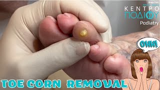 Toe Corn Removal feet toe κεντροποδιου foot podologos calluses podiatrist corn footcare [upl. by Ambur872]