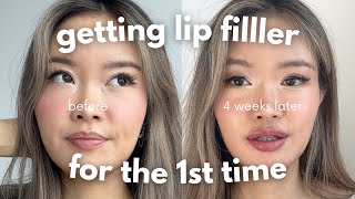 first time getting lip filler  4 week healing process vlog [upl. by Darren]