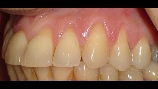 Gingival Recession treatment utilizing a connective tissue graft [upl. by Leesen]