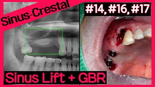 Online Surgery 16 17 OneCAS amp 14 GBR using A Oss Collagen [upl. by Ahtanaram345]