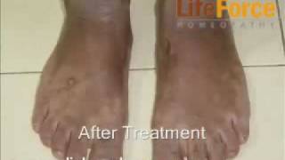 Treatment Lichen Planus on Hands amp Feet Before After Treatment Photos [upl. by Adiuqal]