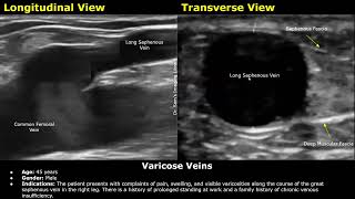 Varicose Veins Doppler Ultrasound Report Example  Lower Limb Venous Insufficiency Sonography USG [upl. by Hcurab]