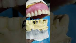 Upper Complete Denture 😁😁😁 Teeth Arrangement By Haider 😁😁😁 [upl. by Auehsoj]