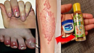 ठंड में खुजली व हाथ पैरों की उंगलियों की सूजन को करे जड़ से खत्म Feet and hand Swelling In Winter [upl. by Henning]