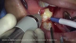 PIEZOSURGERY®  Dr Roberta Grassi Extraction of Impacted Third Molar with Piezo Levers [upl. by Eintruok377]