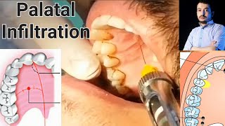 Local Anesthesia Palatal Infiltration Technique Maxillary Anesthesia Techniques dentistry [upl. by Aidiruy]