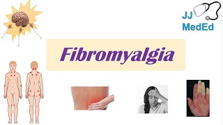 Fibromyalgia  Symptoms Associated Conditions Diagnosis Treatment [upl. by Eelibuj]