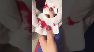 Drilling Into your Nail  trephination in nail hematoma [upl. by Neelcaj564]