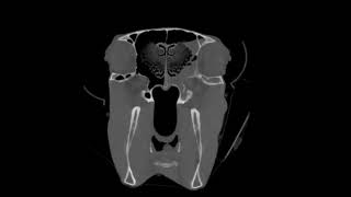 Ethmoid Hematoma [upl. by Tenaej27]