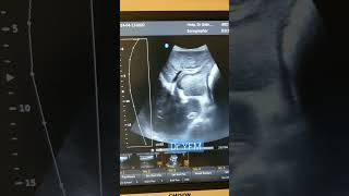 25 yrs old male Periportal fibrosis  Schistosomiasis [upl. by Rebm]