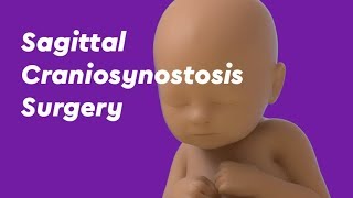 Sagittal Craniosynostosis Surgery [upl. by Name]