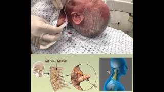 CERVICAL RADIOFREQUENCY ABLATION [upl. by Gerrilee]