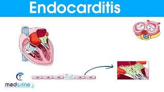 Endocarditis  causes symptoms pathophysiology diagnosis and treatment [upl. by Ardnahc844]