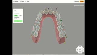 Expansión ArchForm vs Titan Dental [upl. by Nivlak363]