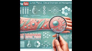 Lichen Planus Clinical Overview and Management [upl. by Assilak641]