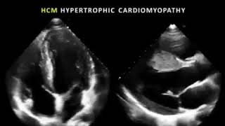 Hypertrophic Cardiomyopathy  HCM  Echo clip [upl. by Fabrin]