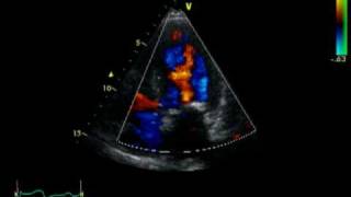 HOCM  AORTIC STENOSIS  LVOT FLOW [upl. by Anor347]