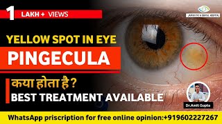 पिंगेकुला क्या होता है कारण लक्षण और उपचार  Pinguecula Causes Symptoms and Treatment [upl. by Tiertza]