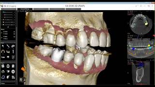 Carestream CS 3D Imaging Implant Workflows  Streamhealth Dental [upl. by Pascasia]