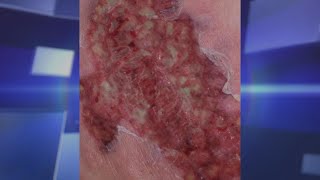 Pyoderma Gangrenosum – Could It Happen To You [upl. by Mirna300]