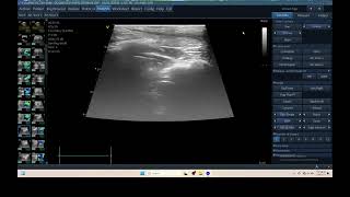 IQ 325 TFAST ULTRASOUND PULMONARY EFFUSION [upl. by Hanson426]