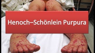 HenochSchönlein Purpura [upl. by Hanavas]