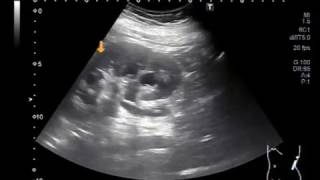 Ultrasound Video showing Stent and stones in the Ureter [upl. by Haisej]