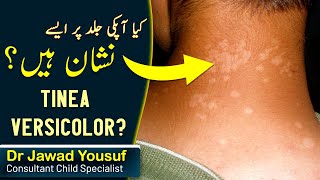 Tinea versicolor skin infection children  treatment  Causes  In Hindi Urdu Healers Online [upl. by Orman391]