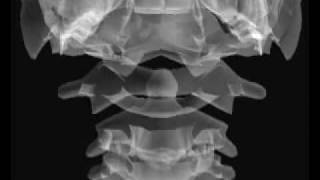 Odontoid Positioning tutorial [upl. by Moraj]