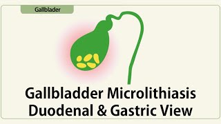 Gallbladder Microlithiasis Duodenal amp Gastric View [upl. by Ailemaj]