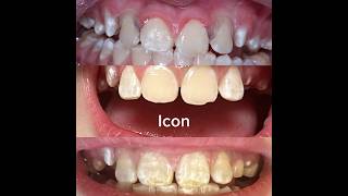 Icon infiltration minimally invasive therapies for anterior teeth with enamel defects MITFATWED [upl. by Sicular859]