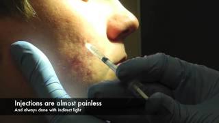 Dermal Fillers for acne scars [upl. by Jolanta]