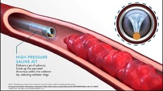 JETi Hydrodynamic Thrombectomy System Method of Action MOA Animation [upl. by Elbertina]