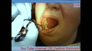 Infiltration anesthesia for treatment 44 toothlocalanaesthesia nerveblock [upl. by Urita802]