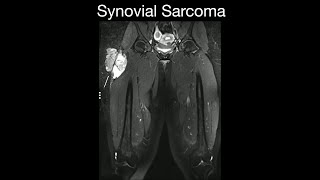 Synovial Sarcoma 1 [upl. by Eah316]