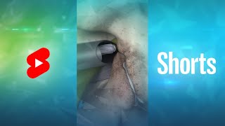 What is Endoscopic Lumbar Foraminotomy Shorts [upl. by Means]