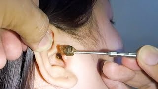 Removing One HUGE EARWAX Stuck in Womans Ear [upl. by Sharron]