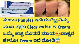 Nilac Cream Review in kannadaUsesside effectssafety Advice acneremoval pimplefree skincare [upl. by Latrell106]