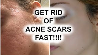 HOW TO GET RID OF ACNE SCARS  Pershii [upl. by Carry]