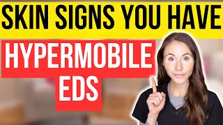 Unlocking The Secrets 12 Surprising Skin Signs Of Hypermobile EhlersDanlos Syndrome [upl. by Eicrad]