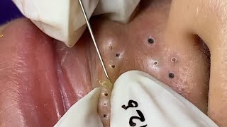 Big Cystic Acne Blackheads Extraction Blackheads amp Milia Whiteheads Removal Pimple Popping  3399 [upl. by Abijah]