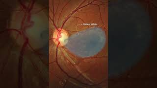 Optic disc pit maculopathy [upl. by Sandie]