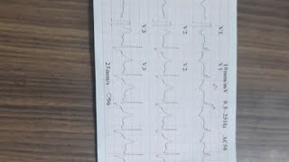 LEARN ECG VENTRICULAR BIGEMINY WITH RBBB IN 2 MINUTES [upl. by Ahsotan]