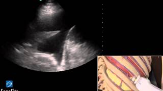 3D Lehrvideo Ultraschallgestütze Thoracentesis Untersuchung  SonoSite Ultraschall [upl. by Keyes]